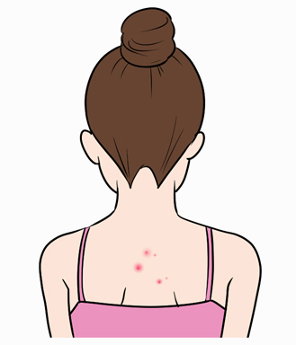 にきび肌の脱毛